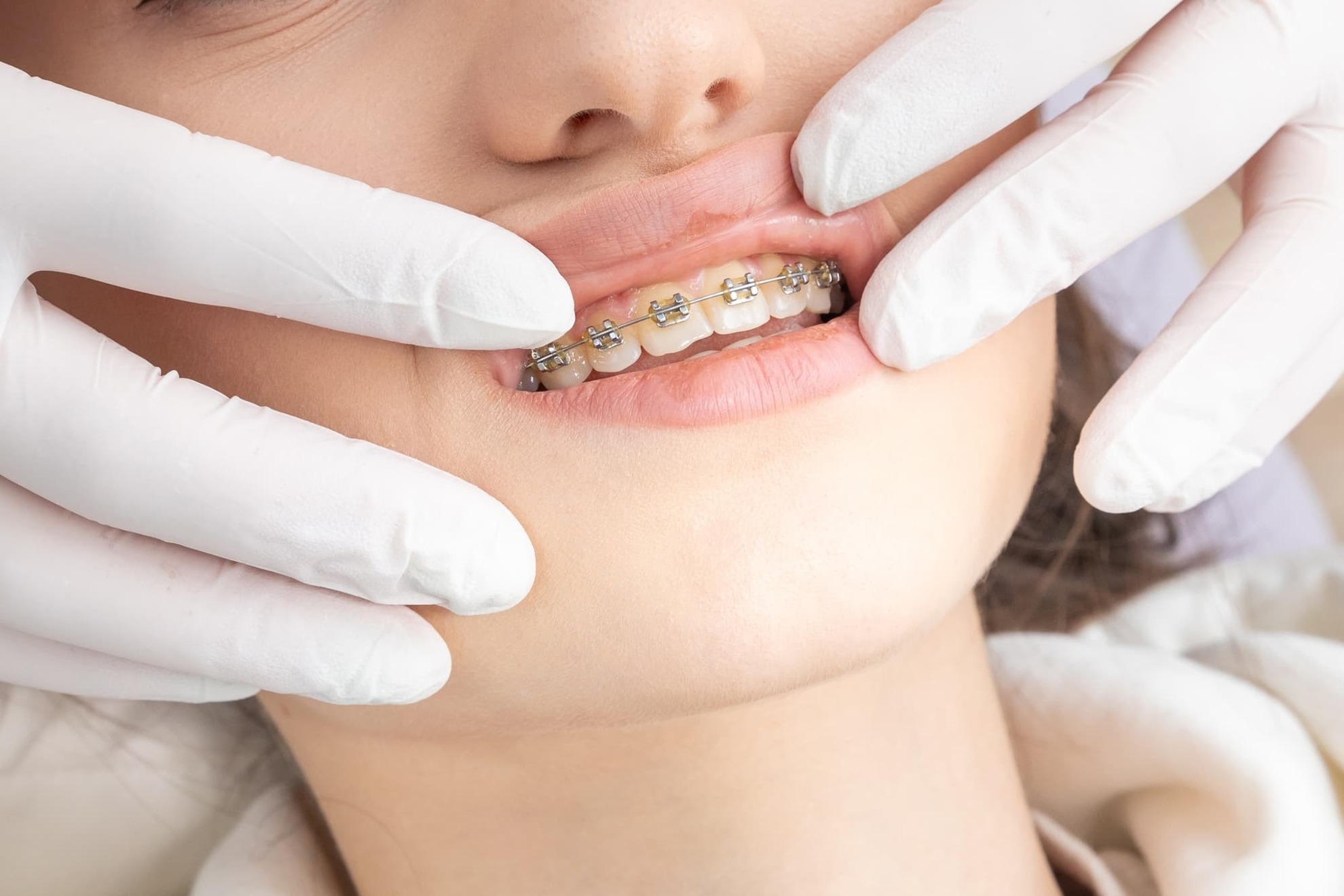 ワイヤー矯正の装置を装着した女性の口元と確認する歯科医師の手
