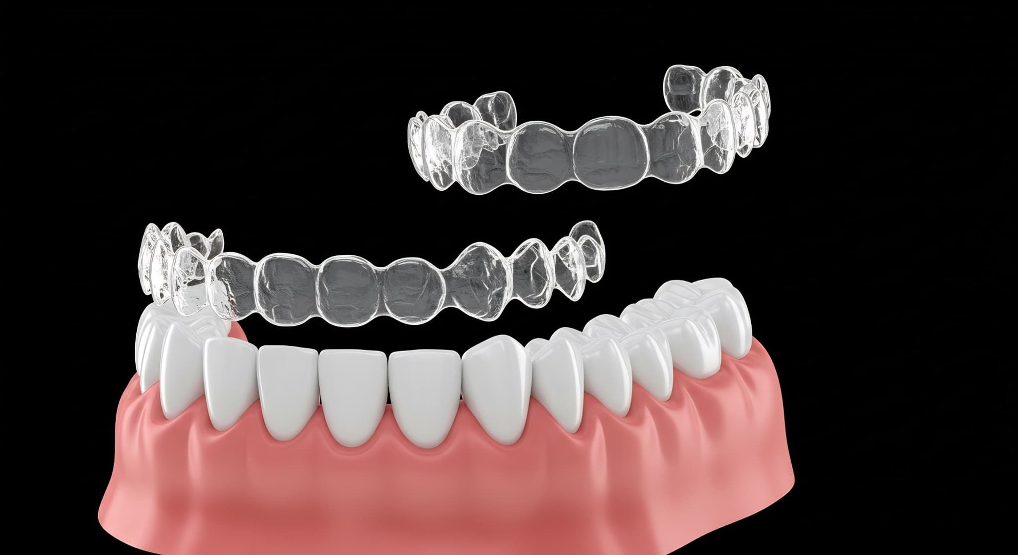 マウスピース矯正の装置が浮く原因を説明するイメージ