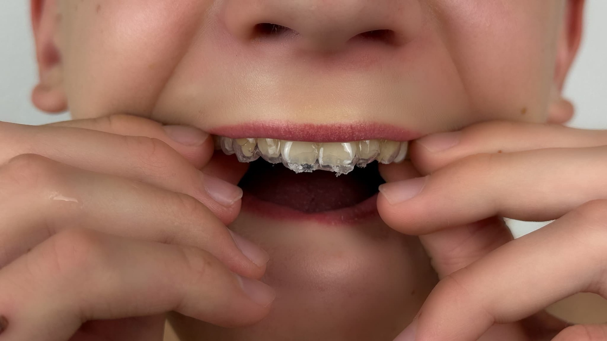 インビザライン・ファーストを装着する男の子