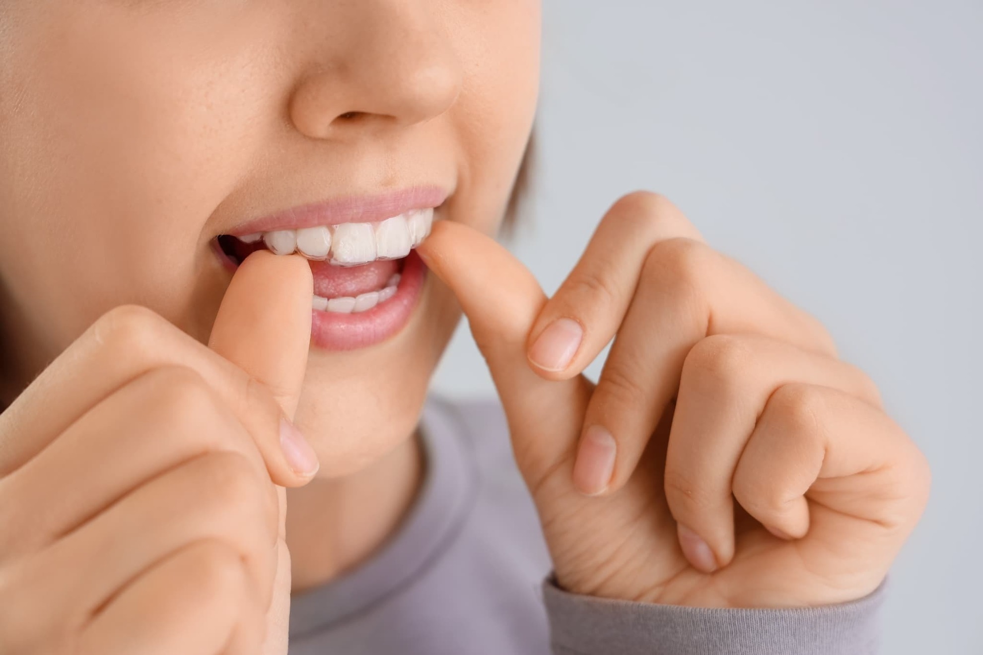 マウスピース矯正の装置が浮くのが気になる女性