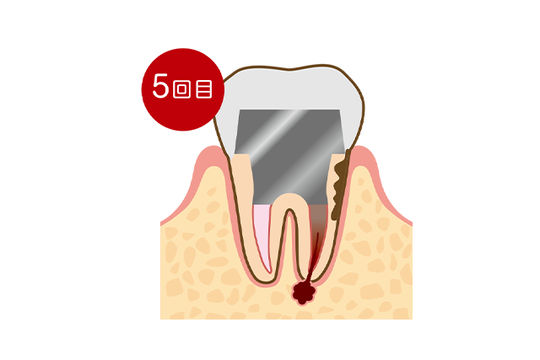 成田市・酒々井の虫歯治療・銀歯を繰り返している方へ