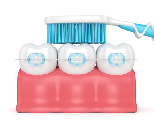 ワイヤー矯正中に歯みがきをするイメージ