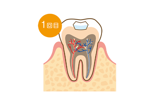 成田市・酒々井の虫歯治療・銀歯を繰り返している方へ