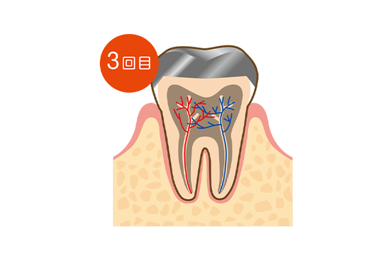 成田市・酒々井の虫歯治療・銀歯を繰り返している方へ