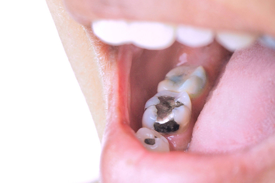 成田市・酒々井のセラミック治療