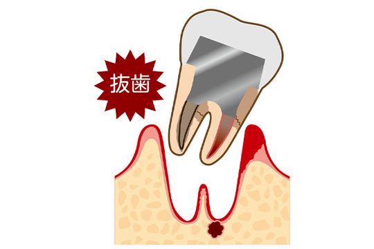 成田市・酒々井の虫歯治療・銀歯を繰り返している方へ