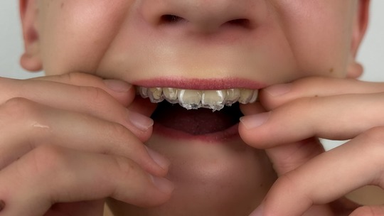 インビザライン・ファーストを装着する男の子