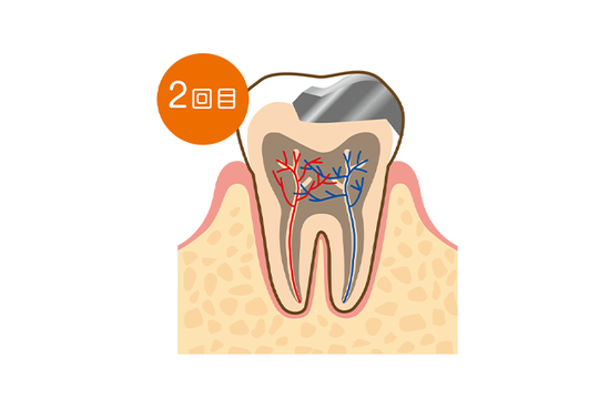 成田市・酒々井の虫歯治療・銀歯を繰り返している方へ