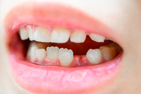 乳歯を失った子供の口元