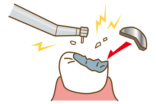 成田市・酒々井の虫歯治療・銀歯を繰り返している方へ