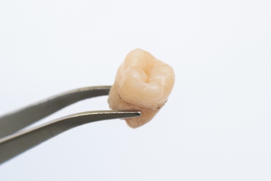 酒々井町の親知らずの抜歯・治療