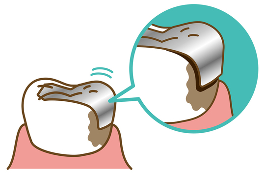 成田市・酒々井の虫歯治療・銀歯を繰り返している方へ
