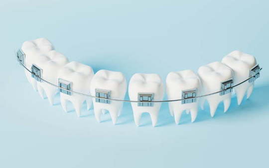 ワイヤー矯正のイメージ