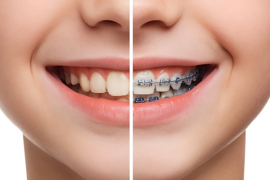 ワイヤー矯正のビフォーアフター