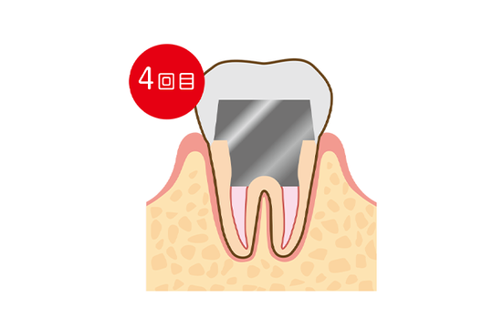 成田市・酒々井の虫歯治療・銀歯を繰り返している方へ