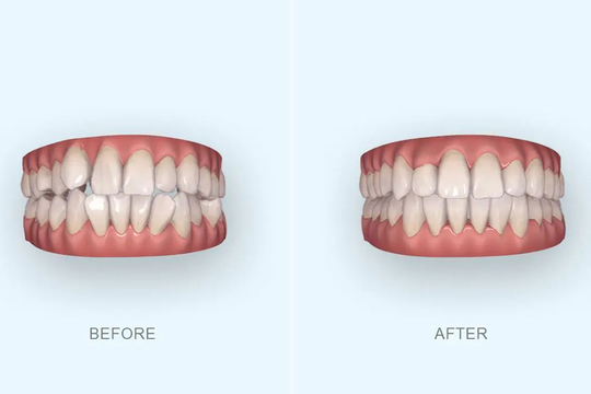 酒々井町の10代後半から30代の方向けの非抜歯矯正