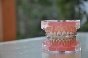 ワイヤー矯正の治療の流れを解説！治療期間や通院が必要な理由も