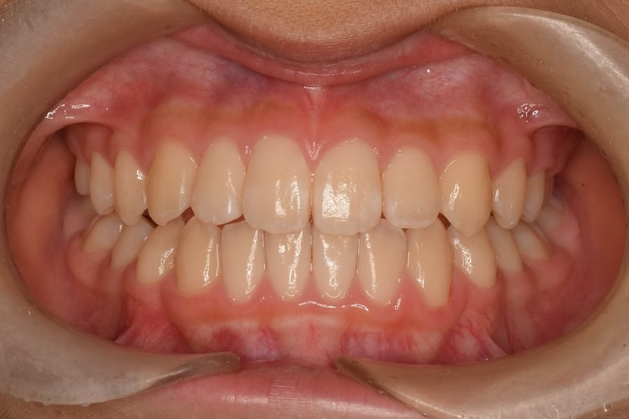 小児矯正から成人矯正への二段階治療による叢生の治療 治療後 正面（永久歯がそろった後・非抜歯）